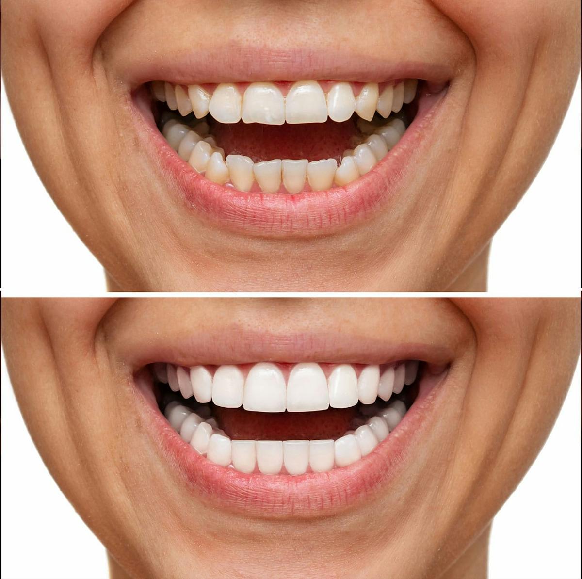 Smile Makeover  Before & After Gallery - Patient 371081 - Image 1