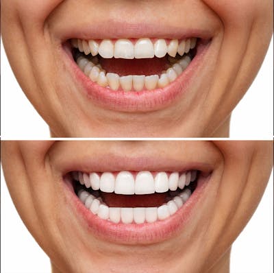 Smile Makeover  Before & After Gallery - Patient 371081 - Image 1