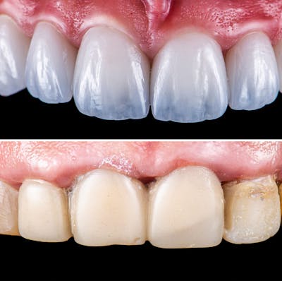Smile Makeover  Before & After Gallery - Patient 218741 - Image 1