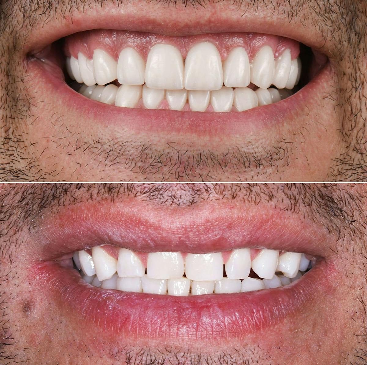 Smile Makeover  Before & After Gallery - Patient 906383 - Image 1