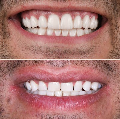 Smile Makeover  Before & After Gallery - Patient 906383 - Image 1