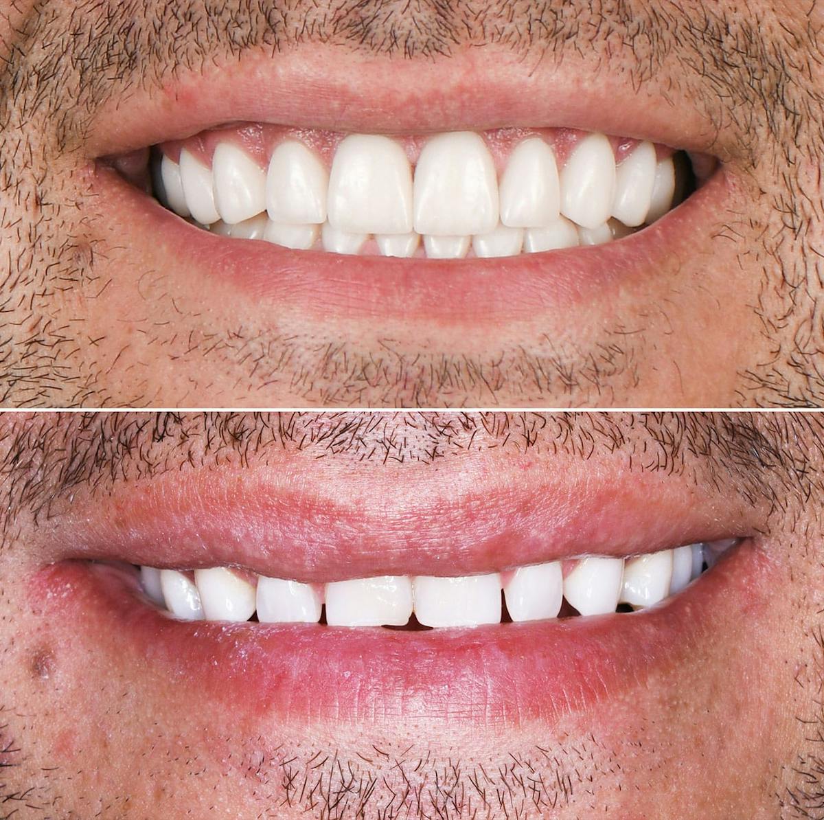 Smile Makeover  Before & After Gallery - Patient 202362 - Image 1