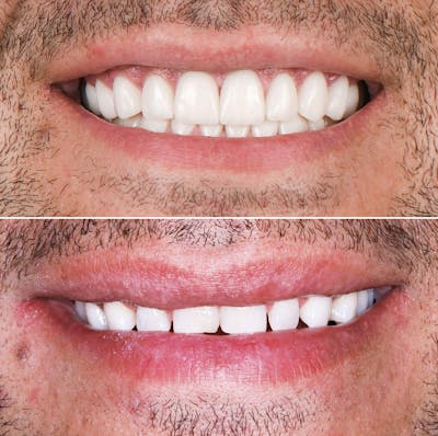 Smile Makeover  Before & After Gallery - Patient 202362 - Image 1