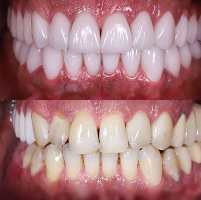 Smile Makeover  Before & After Gallery - Patient 356547 - Image 1