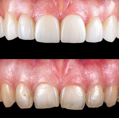 Smile Makeover  Before & After Gallery - Patient 161669 - Image 1