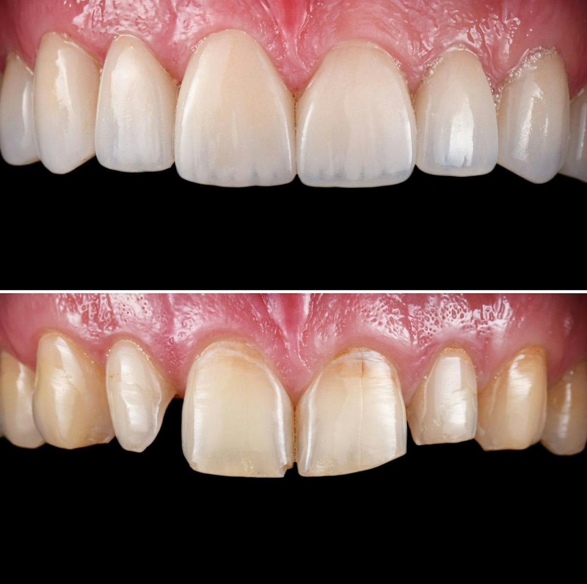Smile Makeover  Before & After Gallery - Patient 172046 - Image 1