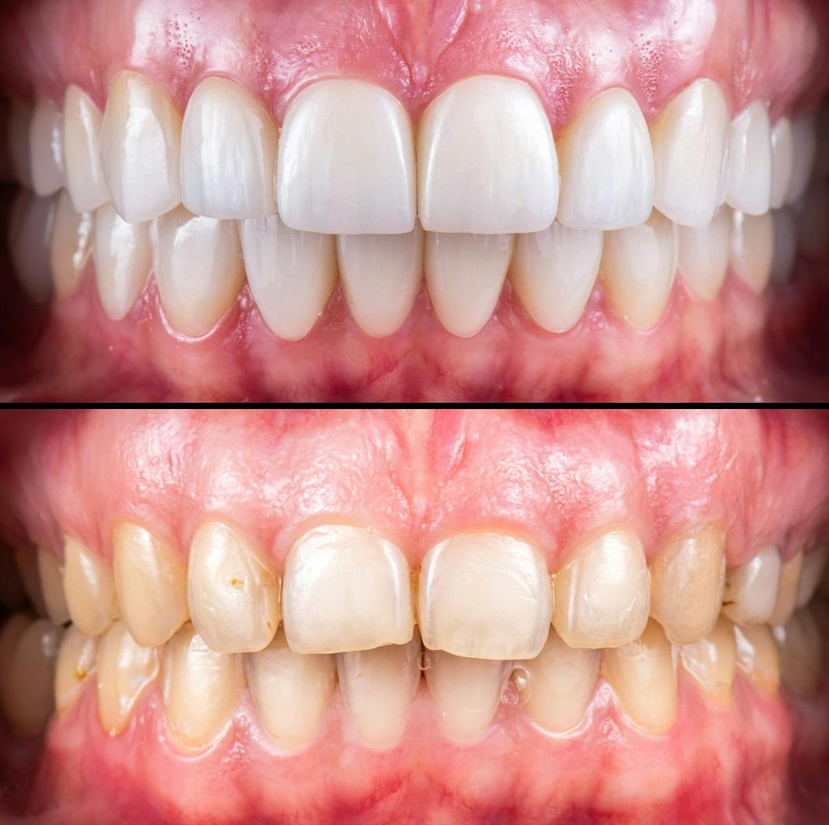 Smile Makeover  Before & After Gallery - Patient 417744 - Image 1