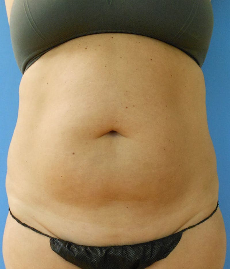 Abdomen Before & After Gallery - Patient 51821524 - Image 3