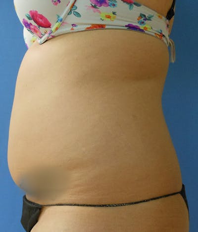 Abdomen Before & After Gallery - Patient 51821525 - Image 1