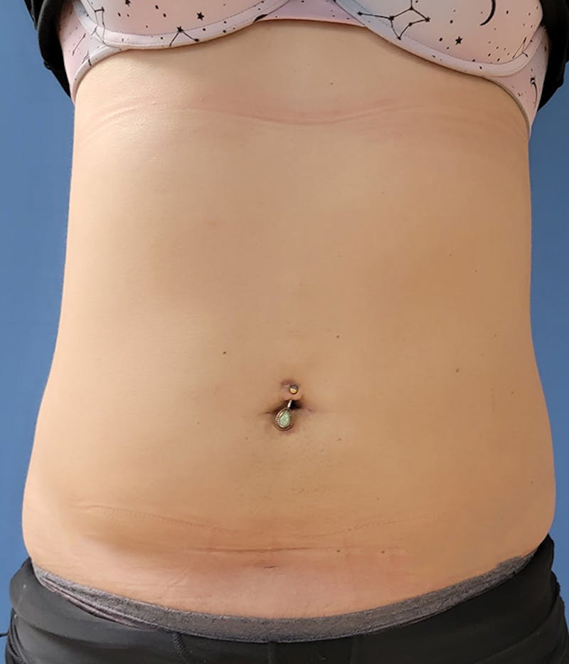 Abdomen Before & After Gallery - Patient 51821525 - Image 4