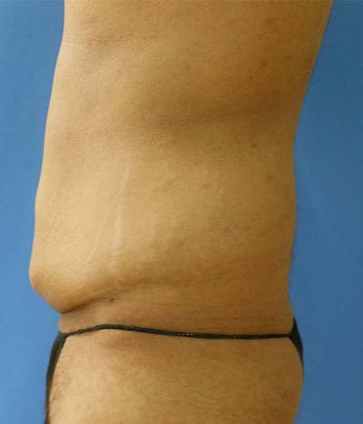 Abdomen Before & After Gallery - Patient 51821526 - Image 1