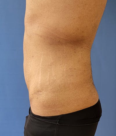 Abdomen Before & After Gallery - Patient 51821526 - Image 2