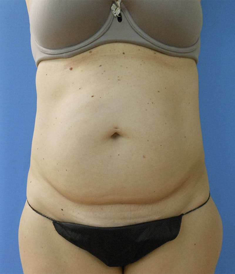 Abdomen Before & After Gallery - Patient 51821543 - Image 1