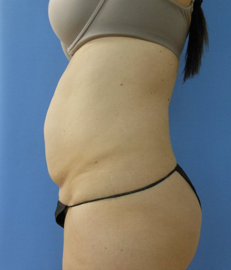 Abdomen Before & After Gallery - Patient 51821543 - Image 3