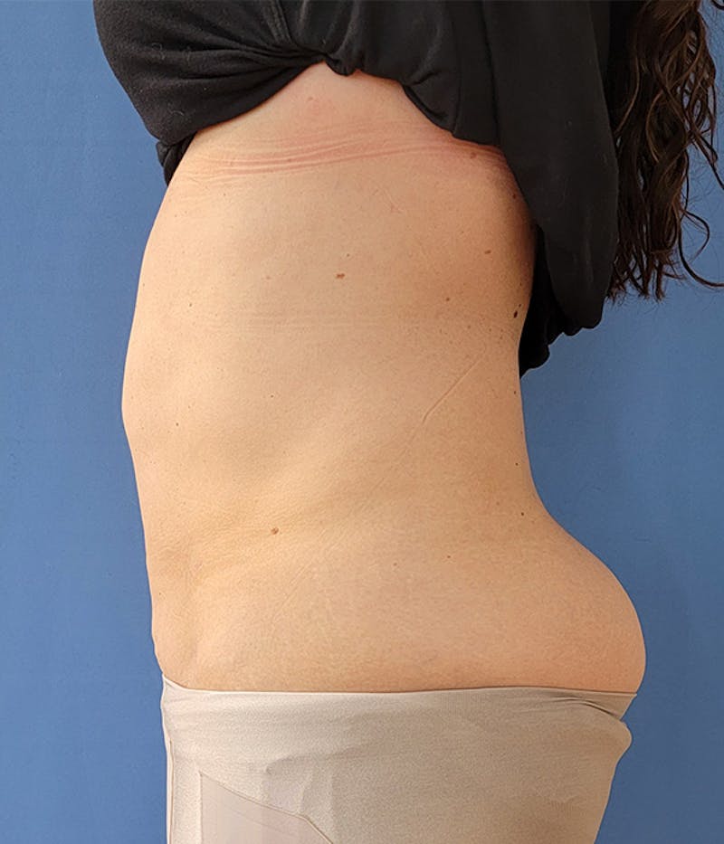 Abdomen Before & After Gallery - Patient 51821543 - Image 4