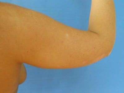 Arms Before & After Gallery - Patient 51821544 - Image 1