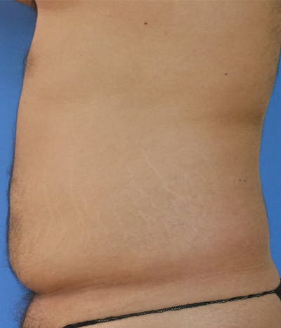 Abdomen Before & After Gallery - Patient 51821545 - Image 1