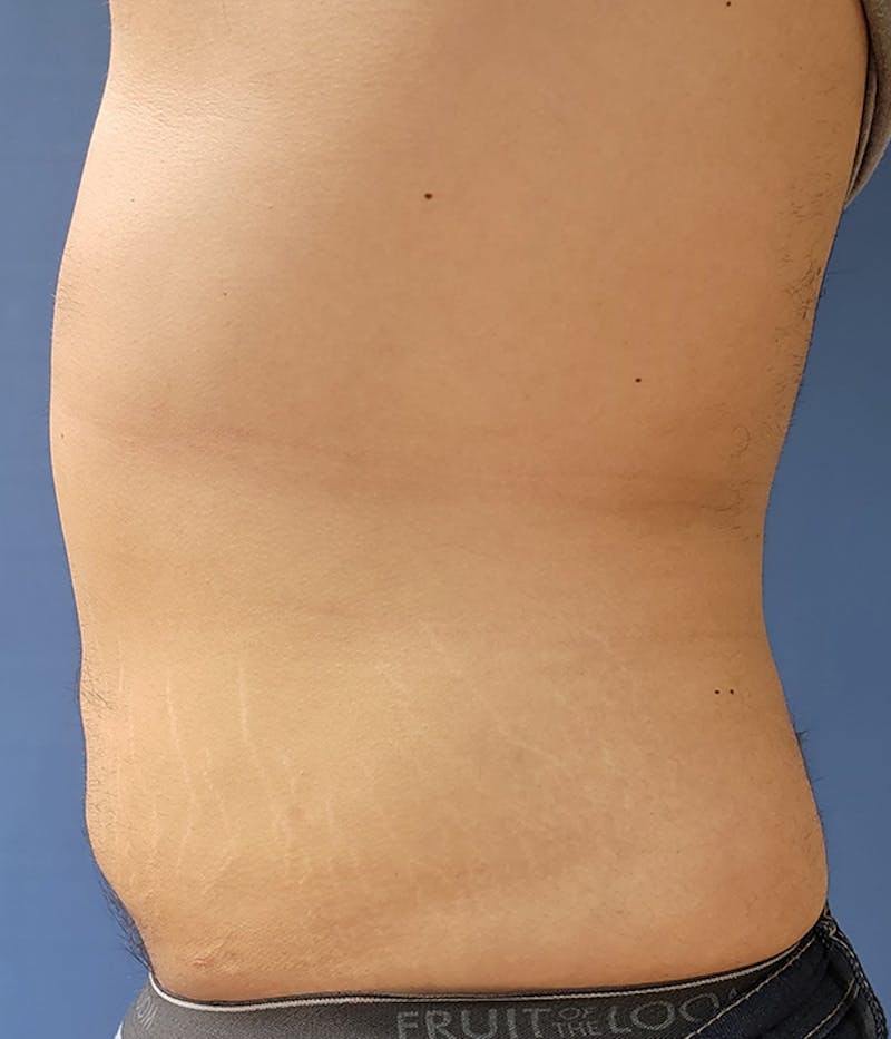 Abdomen Before & After Gallery - Patient 51821545 - Image 2