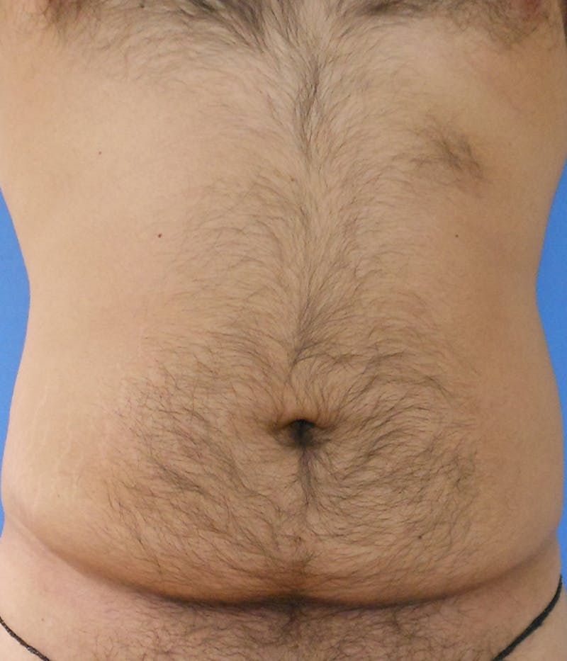 Abdomen Before & After Gallery - Patient 51821545 - Image 3