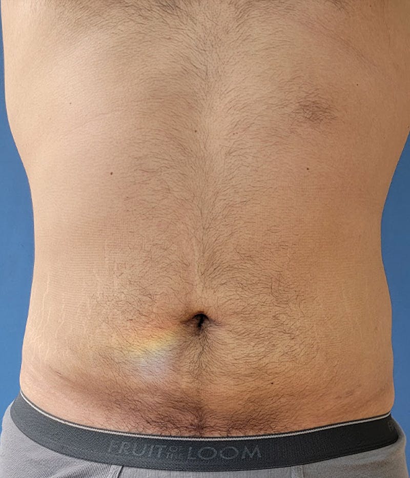 Abdomen Before & After Gallery - Patient 51821545 - Image 4