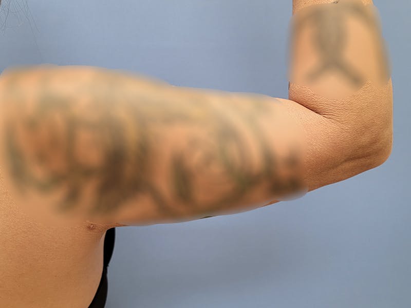 Arms Before & After Gallery - Patient 51821547 - Image 4