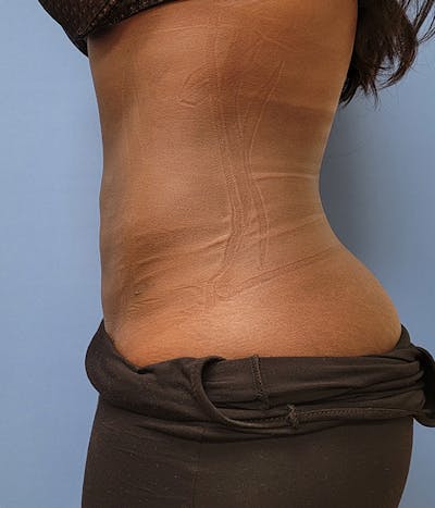 Abdomen Before & After Gallery - Patient 51821548 - Image 2
