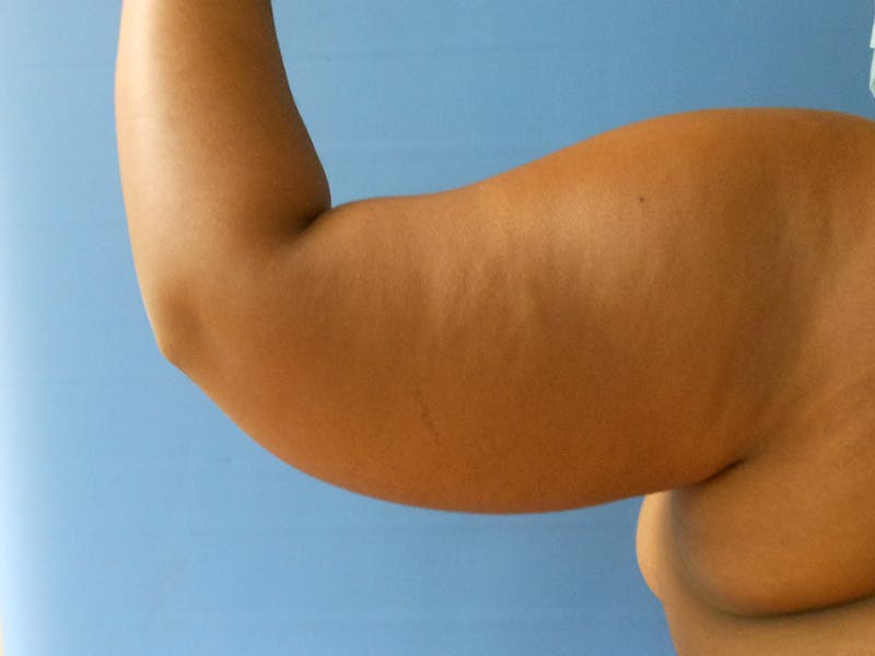 Arms Before & After Gallery - Patient 51821550 - Image 1