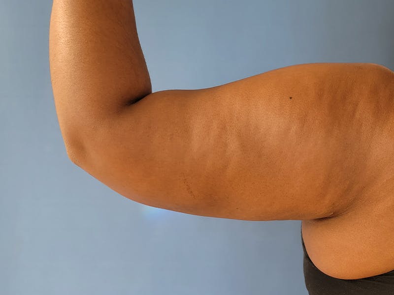 Arms Before & After Gallery - Patient 51821550 - Image 2