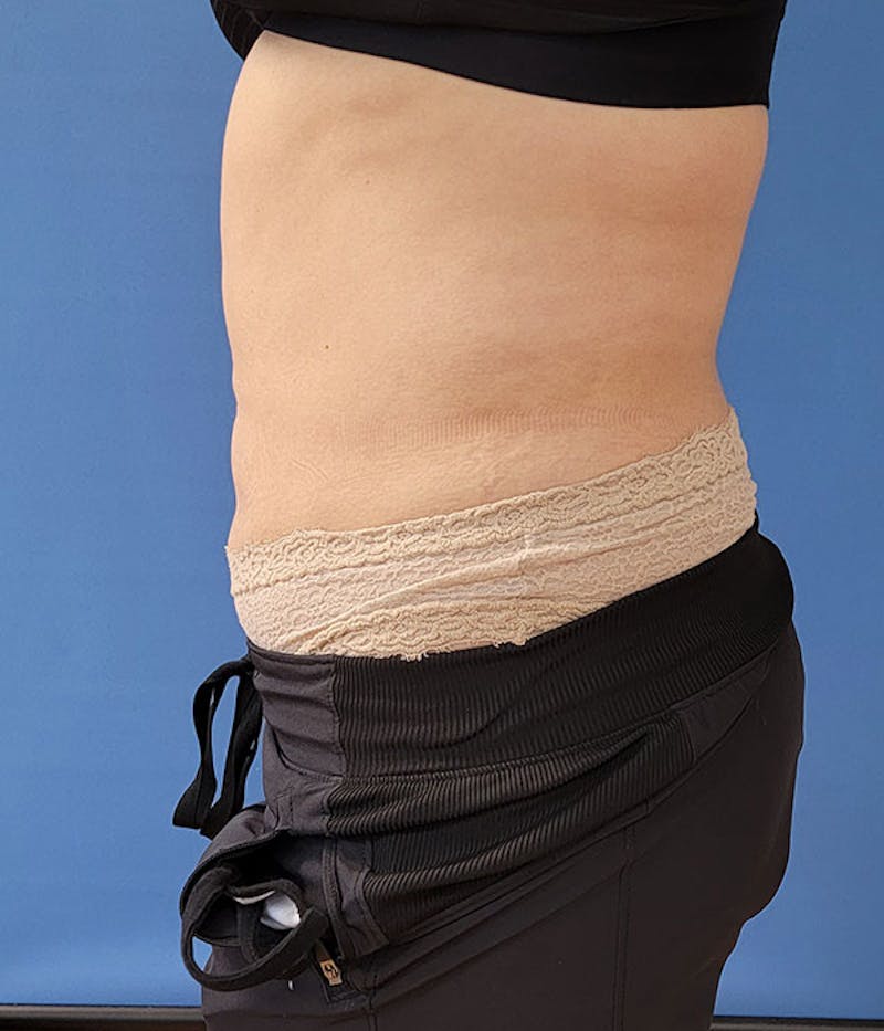 Abdomen Before & After Gallery - Patient 51821551 - Image 2