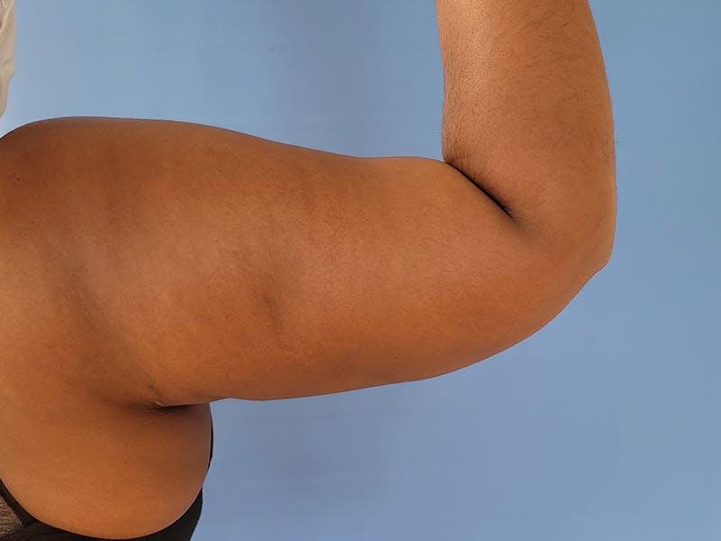 Arms Before & After Gallery - Patient 51821550 - Image 4