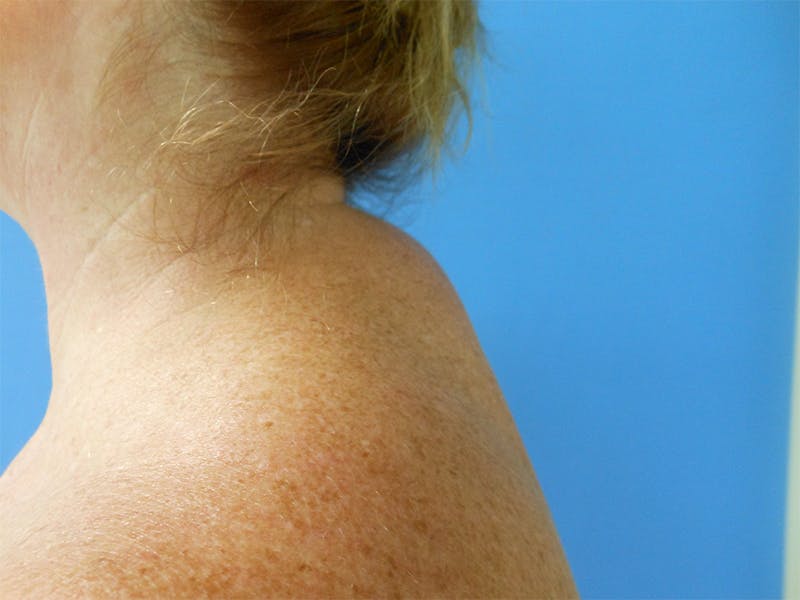 Buffalo Hump Before & After Gallery - Patient 51821552 - Image 1