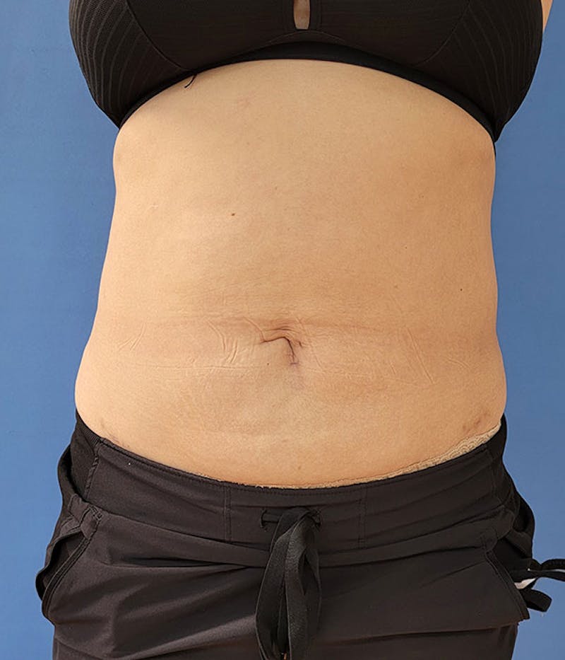 Abdomen Before & After Gallery - Patient 51821551 - Image 4