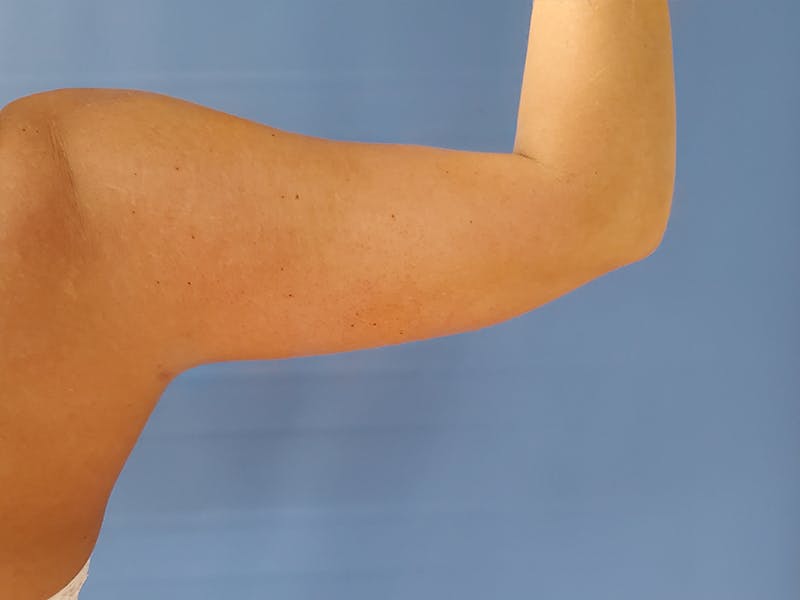 Arms Before & After Gallery - Patient 51821553 - Image 1