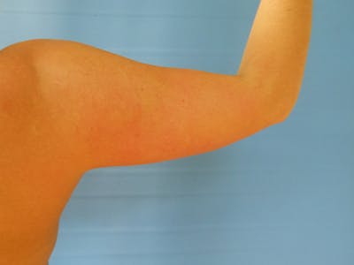 Arms Before & After Gallery - Patient 51821553 - Image 2