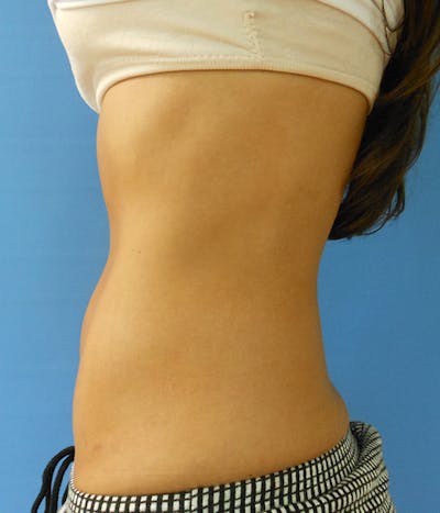Abdomen Before & After Gallery - Patient 51821555 - Image 2