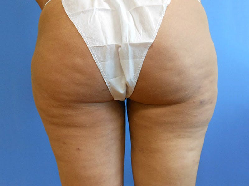 Buttocks Before & After Gallery - Patient 51821556 - Image 1