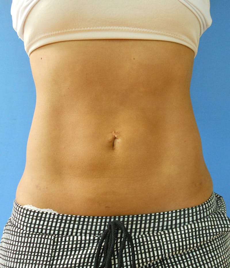 Abdomen Before & After Gallery - Patient 51821555 - Image 4