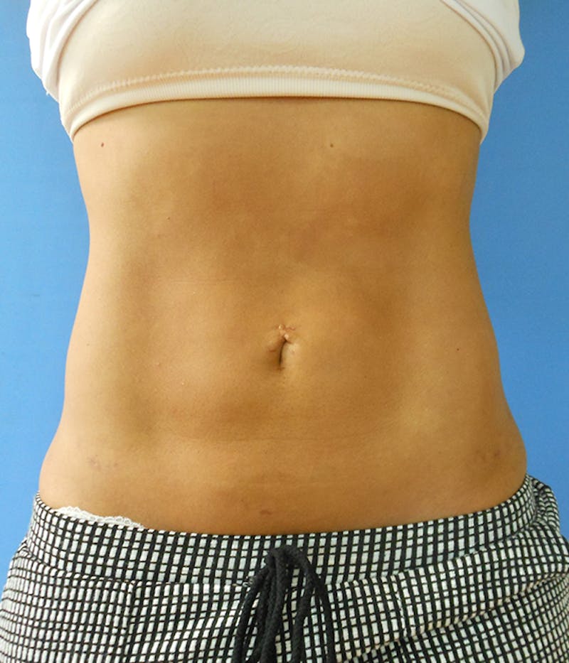 Abdomen Before & After Gallery - Patient 51821555 - Image 4