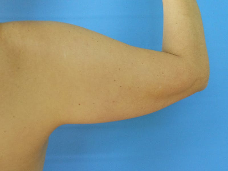 Arms Before & After Gallery - Patient 51821562 - Image 1