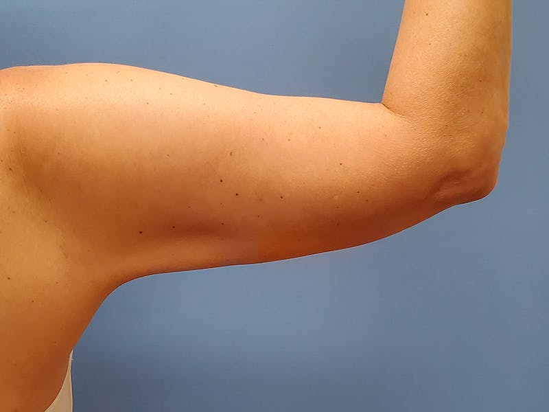 Arms Before & After Gallery - Patient 51821562 - Image 2