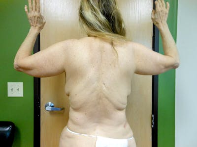 Flanks Before & After Gallery - Patient 51821559 - Image 1