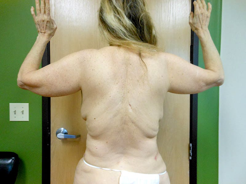 Flanks Before & After Gallery - Patient 51821559 - Image 1