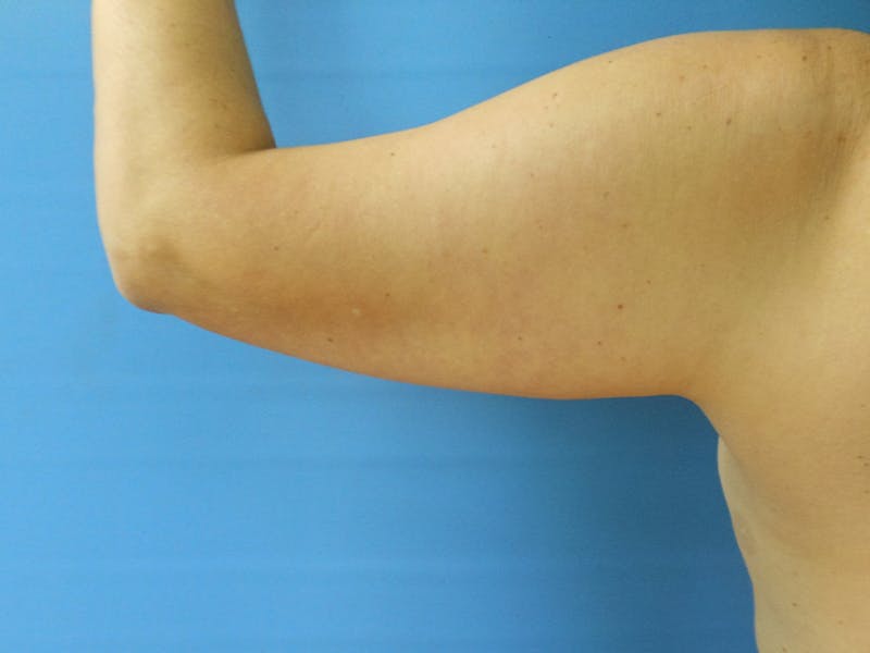 Arms Before & After Gallery - Patient 51821562 - Image 3