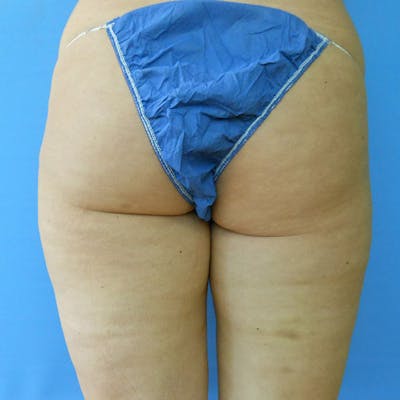 Buttocks Before & After Gallery - Patient 51821561 - Image 1