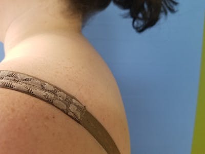 Buffalo Hump Before & After Gallery - Patient 51821560 - Image 2