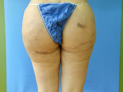 Buttocks Before & After Gallery - Patient 51821566 - Image 1