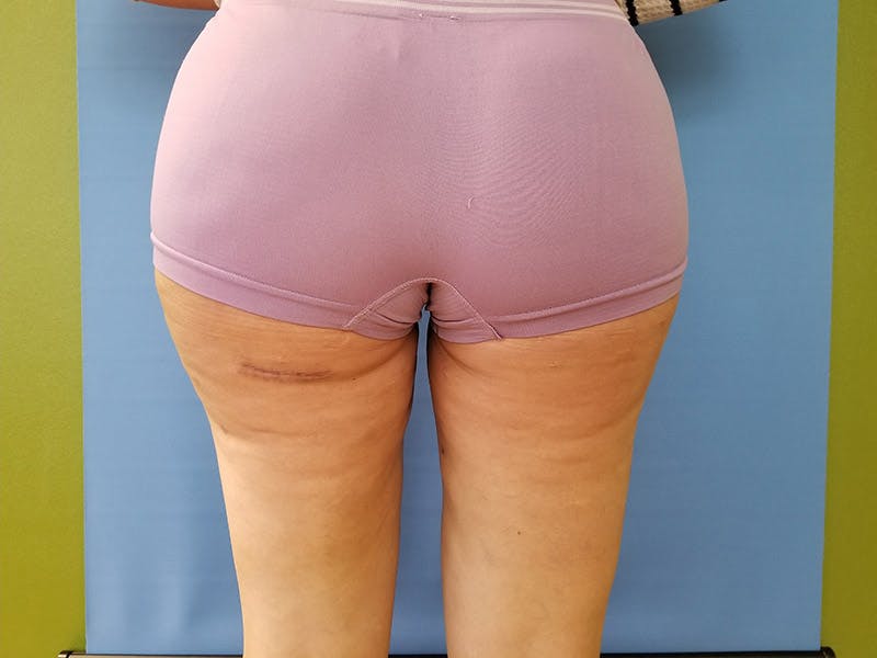 Buttocks Before & After Gallery - Patient 51821566 - Image 2