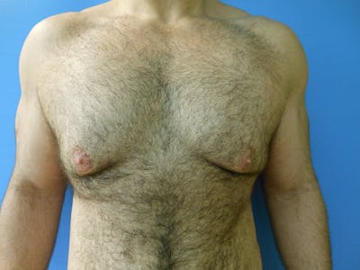 Gynecomastia Before & After Gallery - Patient 51821569 - Image 1