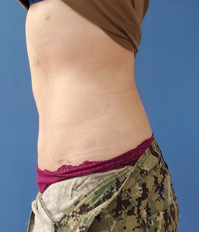 Abdomen Before & After Gallery - Patient 51821567 - Image 2