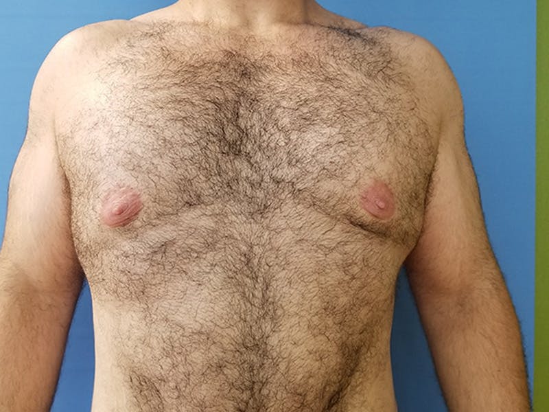 Gynecomastia Before & After Gallery - Patient 51821569 - Image 2